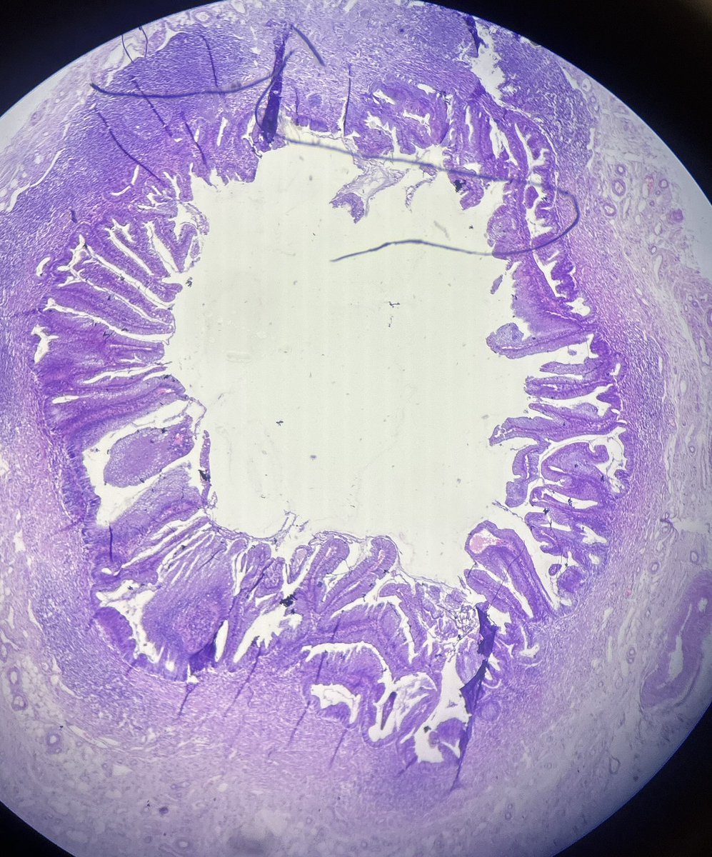 Simrangil128's tweet photo. 67 years female with h/o repeated obstruction.#appendix specimen #pathology case #git https://t.co/RmxPeaQEZk