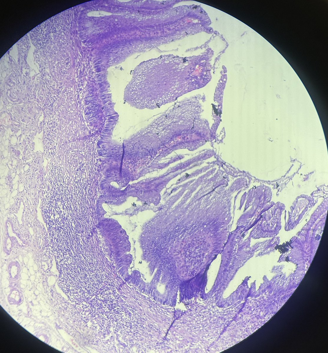 Simrangil128's tweet photo. 67 years female with h/o repeated obstruction.#appendix specimen #pathology case #git https://t.co/RmxPeaQEZk
