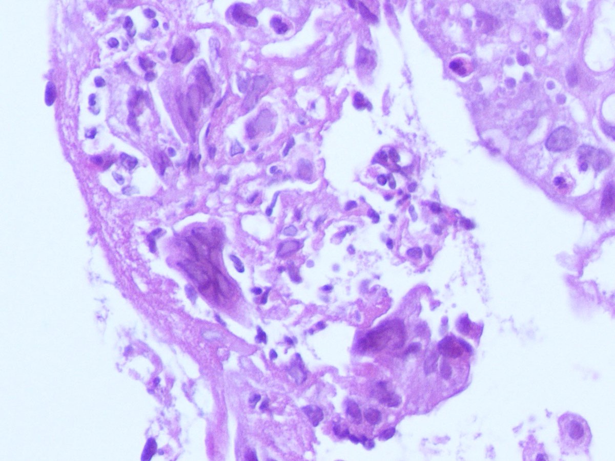 ariella8's tweet photo. #GIPath #Infectiousdiseases #The3Ms #Pathresidents 
What do you say ?
Male patient ,age doesn't matter 
It was supposed to be just another erosive proctitis 🙃 
Always look at the edges 🧐
#PathOutPic https://t.co/ltHHISSvSo