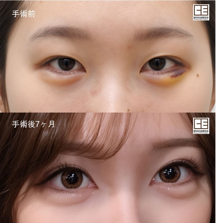 boneeyeps's tweet photo. 💖ボナイ整形外科 目整形💘
▶️切開 再手術 
気になることございましたらいつでも
公式LINEにご連絡ください💌
https://t.co/L32y87w6Yn

再手術も得意とする病院です！！
ボナイ整形外科で大変🫶🏻

#韓国　#整形 #ボナイ整形外科 #切開 #二重  #再手術 https://t.co/dumFQ5UW4t