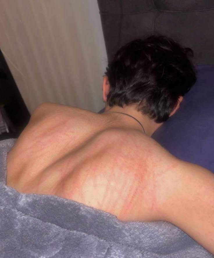 zyoforfun's tweet photo. Scratched someone's back last night. Oh I wish it could heal as fast as possible https://t.co/9LqaduIZyI