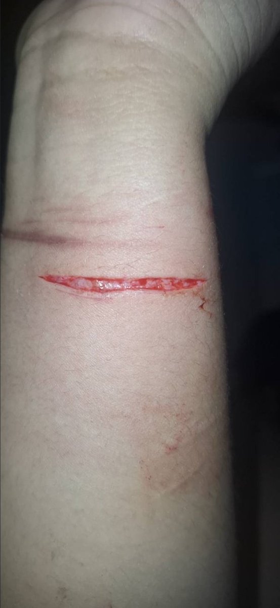 plskillyuorself's tweet photo. realistic depiction of injury for medical purposes. ALL FAKE, IT'S MAKEUP https://t.co/R7hieRix0s