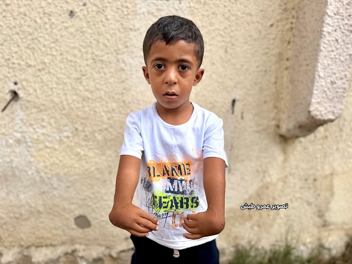 Timesofgaza's tweet photo. Five-and-a-half-year-old Wajed Abu Awwad suffers from a rare congenital deformity affecting both hands, causing severe deviation and the absence of both thumbs, leaving him unable to use his hands normally. Wajed urgently needs specialized surgery to reconstruct his thumbs and travel abroad for treatment, as delaying treatment could result in permanent disability and loss of normal hand function.