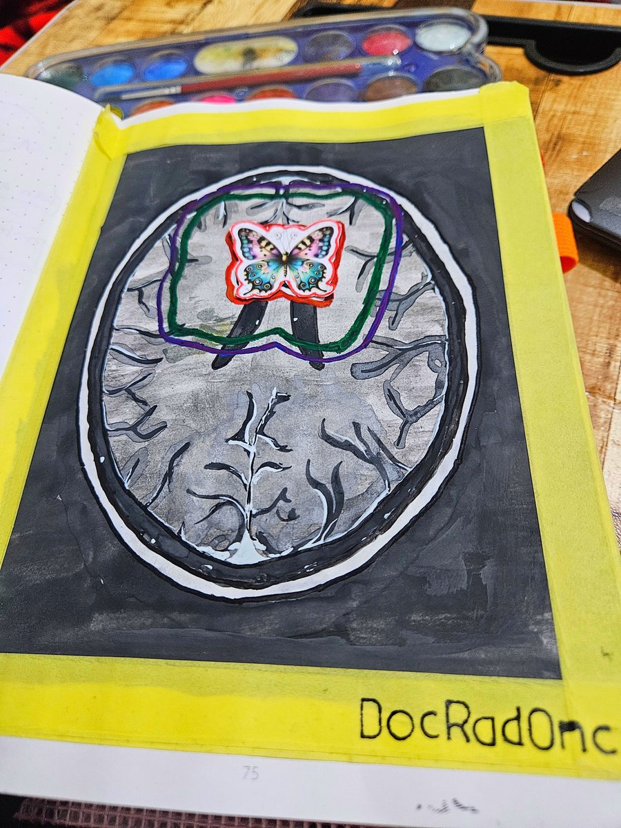 dr_nagma's tweet photo. Painting the treatment volumes of Butterfly Glioma 🦋🎨🖌 
(Dose painting)🙃

#art #meded #radonc #oncology #med #glioma https://t.co/7qlyMBWLM0