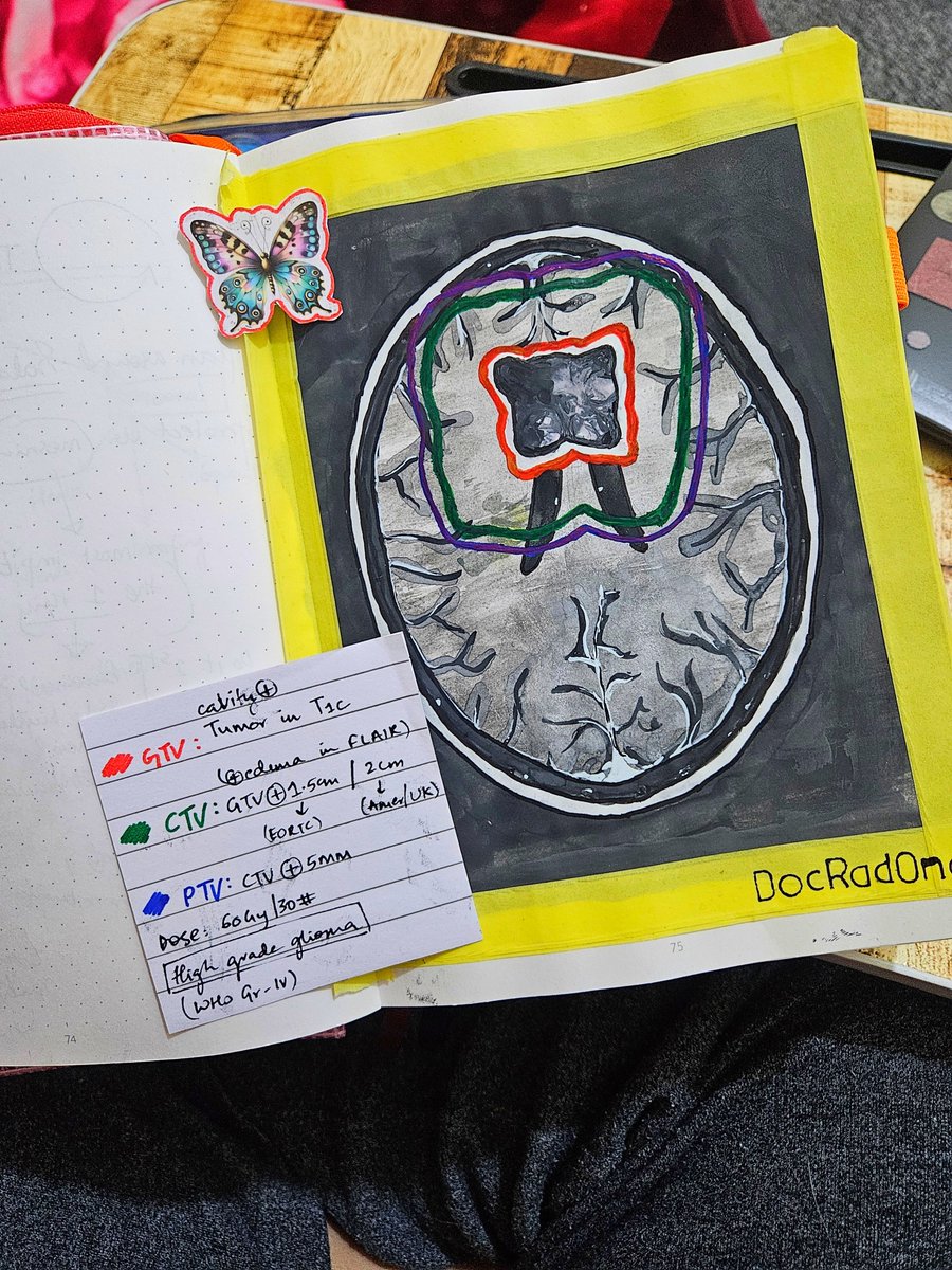 dr_nagma's tweet photo. Painting the treatment volumes of Butterfly Glioma 🦋🎨🖌 
(Dose painting)🙃

#art #meded #radonc #oncology #med #glioma https://t.co/7qlyMBWLM0