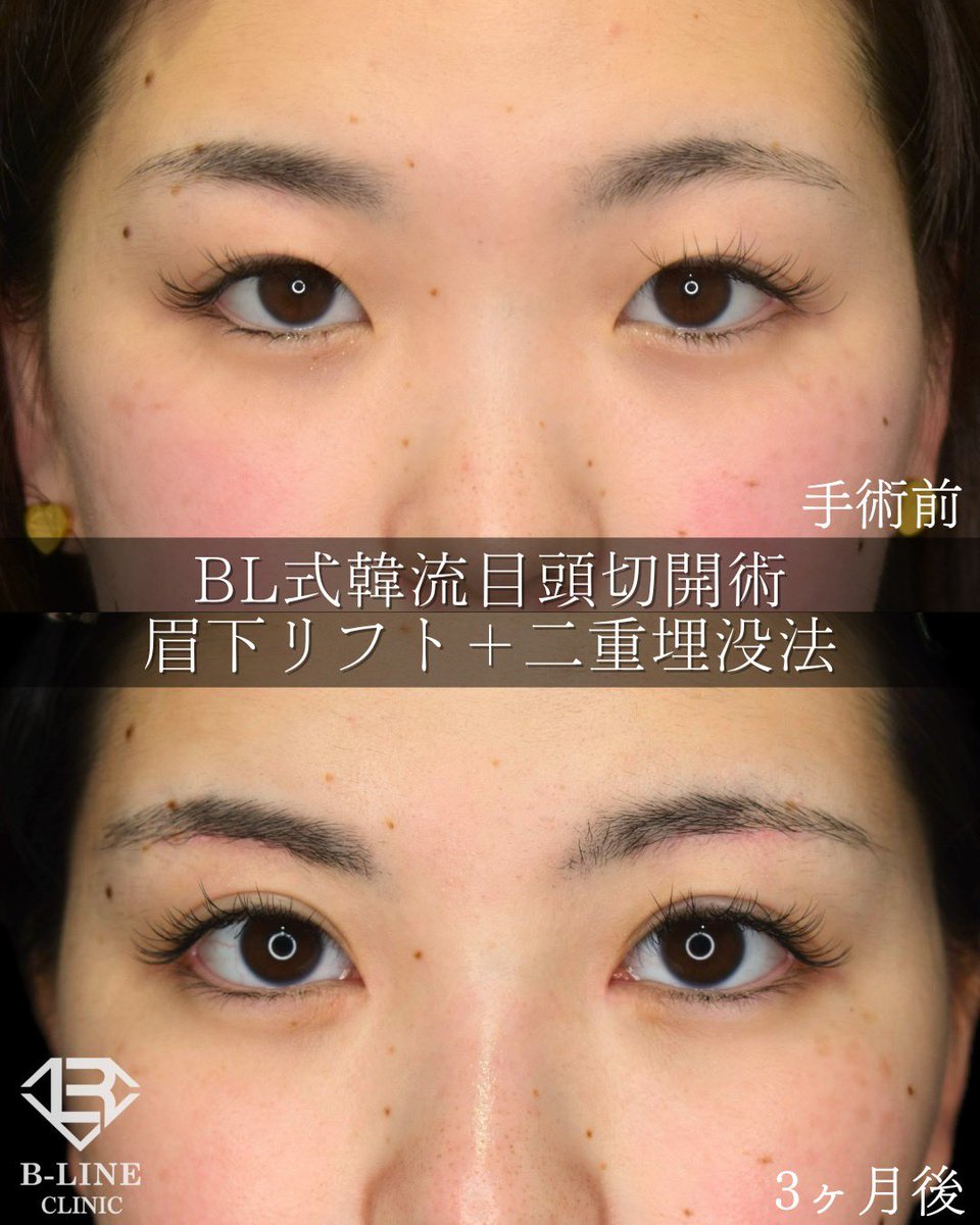 dr_koikeyasu's tweet photo. 【BL式韓流目頭切開術+眉下リフト+二重埋没法】
手術3ヶ月 ⭐️モニター価格15万〜⭐️

まぶたのたるみが無くなり、自然な平行型二重になりました✨
目頭切開の傷跡はどこにあるかわかりますか？
韓流目頭切開は傷跡が内眼角の内側に隠れるように切開・縫合しますので、Z形成よりもさらに傷跡を目立たなくする事ができます!
眉下リフトを併用することで、目と眉の距離が短くなり欧米人のような目鼻立ちのくっきりした印象になります。
ミリ単位での調整とデザインのセンスが必須ですので、経験豊富な美容外科専門医にお任せ下さい！
