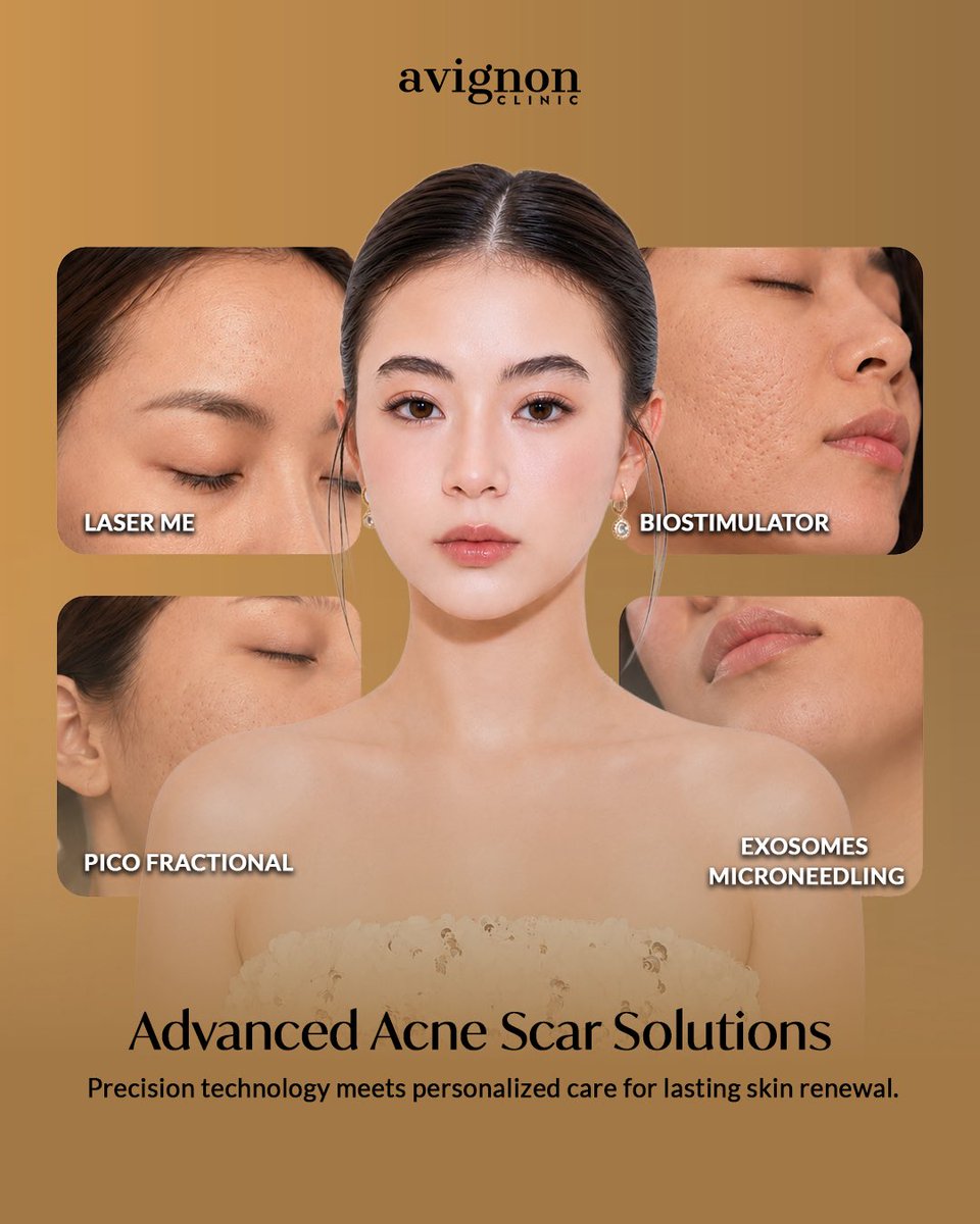 AvignonClinic's tweet photo. You’ve cleared the breakouts… now let’s work on the marks they left behind. 👋

If acne scars, dark spots, or uneven skin texture are keeping you from feeling confident in your bare skin,it’s time to start your skin transformation.

#ThisTimeItsAvignon #AcneScars #AcneTreatment https://t.co/w4pZcxrPMQ