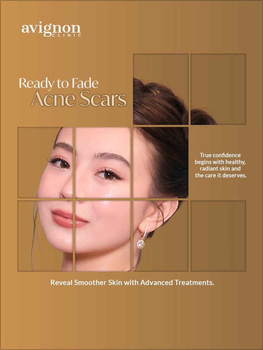 AvignonClinic's tweet photo. You’ve cleared the breakouts… now let’s work on the marks they left behind. 👋

If acne scars, dark spots, or uneven skin texture are keeping you from feeling confident in your bare skin,it’s time to start your skin transformation.

#ThisTimeItsAvignon #AcneScars #AcneTreatment https://t.co/w4pZcxrPMQ