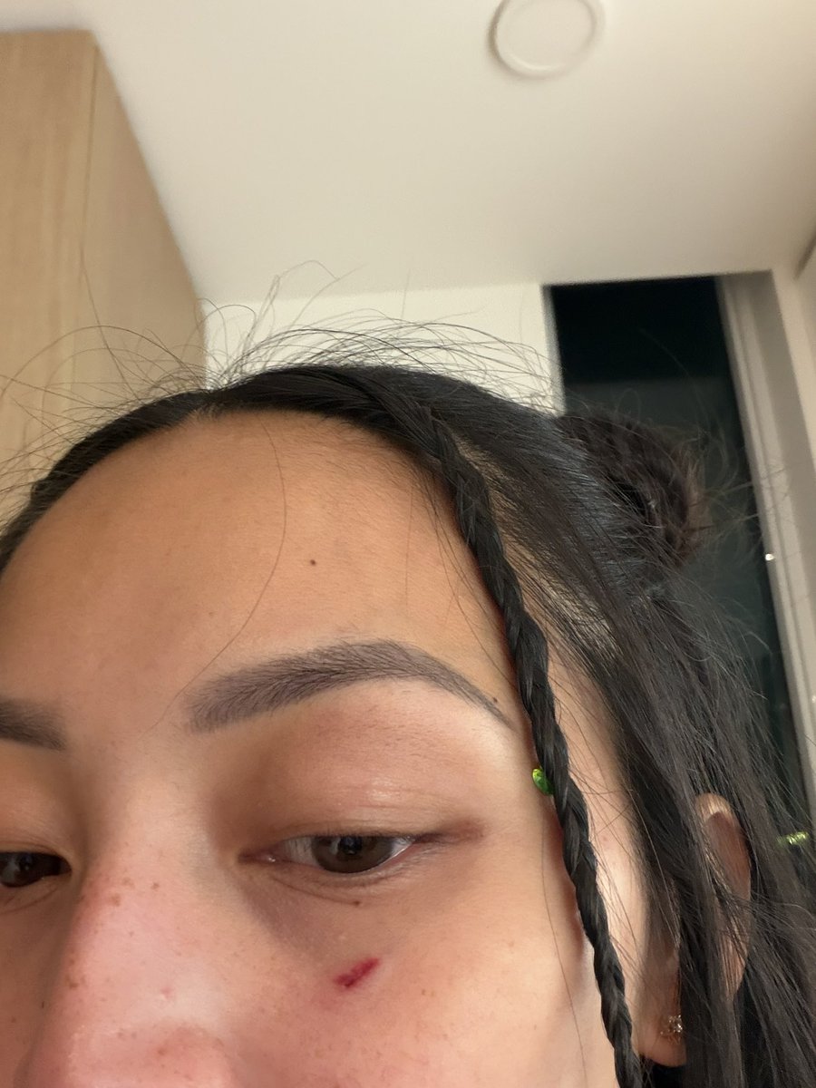 tmhthaila's tweet photo. Got injured by a bathroom sign at @CHBlockParty 😣☹️😪 https://t.co/ZqIXAgl33O