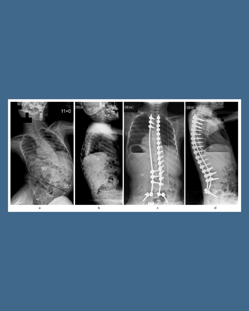 BoneJointOpen's tweet photo. Spinal deformity is a common and severe musculoskeletal condition affecting children with neurological or myopathic disorders.

#Scoliosis #Sugery #Deformity #Pediatrics #BJO

https://t.co/u51gXQx6jX https://t.co/rIJlvtNFxJ