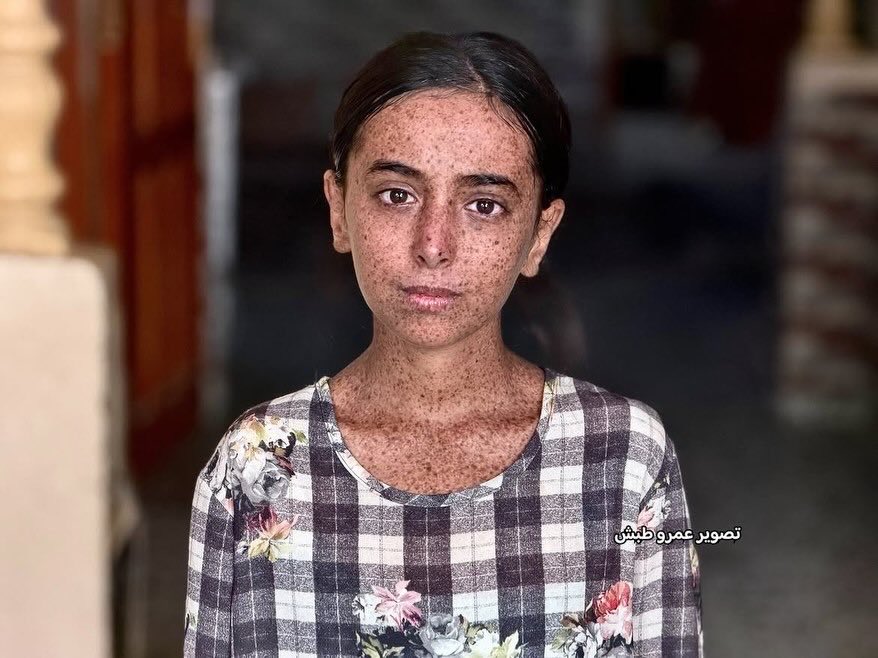 EyeonPalestine's tweet photo. Fourteen-year-old Maes Al-Qedra has suffered since birth from a rare and serious genetic condition known as Xeroderma Pigmentosum (XP), which makes her skin extremely sensitive to sunlight and places her at a high risk of developing skin cancer, alongside complications affecting her vision, cognitive development, and hearing. In addition to the pain of her illness, Maes faces harsh daily struggles with bullying and people’s stares on the street, leaving her afraid to go outside and play like other children. In 2023, Maes underwent surgery to remove a skin-cell tumor, but she still requires specialized examinations, continuous medical follow-up, and the removal of any new tumor cells. She is urgently in need of a medical referral to a specialized center outside Gaza before her condition worsens and the risks become even greater, to save what remains of her childhood. 
To contact the child’s father: 00972594208018.

تعاني الطفلة ميس القدرة، البالغة من العمر 14 عاماً، منذ ولادتها من مرض وراثي نادر وخطير يُعرف بجفاف الجلد المصطبغ (XP)، والذي يسبب لها حساسية شديدة لأشعة الشمس ويعرضها لخطر مرتفع للإصابة بسرطان الجلد، إلى جانب مضاعفات أثرت على بصرها ونموها العقلي وسمعها. تواجه ميس، فضلاً عن آلام المرض، معاناة يومية قاسية مع التنمر ونظرات الناس في الشارع التي تجعلها خائفة من الخروج واللعب كباقي الأطفال. وفي عام 2023، خضعت ميس لعملية لاستئصال ورم من خلايا الجلد، لكنها ما زالت بحاجة ماسة إلى فحوصات متخصصة ومتابعة مستمرة واستئصال أي خلايا ورمية جديدة، وهي تحتاج اليوم بشكل عاجل إلى تحويل طبي إلى مركز متخصص خارج غزة قبل أن تتفاقم حالتها ويصبح الخطر أكبر لإنقاذ طفولتها. للتواصل مع والد الطفلة: 00972594208018.