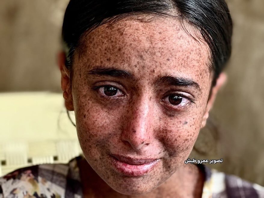 EyeonPalestine's tweet photo. Fourteen-year-old Maes Al-Qedra has suffered since birth from a rare and serious genetic condition known as Xeroderma Pigmentosum (XP), which makes her skin extremely sensitive to sunlight and places her at a high risk of developing skin cancer, alongside complications affecting her vision, cognitive development, and hearing. In addition to the pain of her illness, Maes faces harsh daily struggles with bullying and people’s stares on the street, leaving her afraid to go outside and play like other children. In 2023, Maes underwent surgery to remove a skin-cell tumor, but she still requires specialized examinations, continuous medical follow-up, and the removal of any new tumor cells. She is urgently in need of a medical referral to a specialized center outside Gaza before her condition worsens and the risks become even greater, to save what remains of her childhood. 
To contact the child’s father: 00972594208018.

تعاني الطفلة ميس القدرة، البالغة من العمر 14 عاماً، منذ ولادتها من مرض وراثي نادر وخطير يُعرف بجفاف الجلد المصطبغ (XP)، والذي يسبب لها حساسية شديدة لأشعة الشمس ويعرضها لخطر مرتفع للإصابة بسرطان الجلد، إلى جانب مضاعفات أثرت على بصرها ونموها العقلي وسمعها. تواجه ميس، فضلاً عن آلام المرض، معاناة يومية قاسية مع التنمر ونظرات الناس في الشارع التي تجعلها خائفة من الخروج واللعب كباقي الأطفال. وفي عام 2023، خضعت ميس لعملية لاستئصال ورم من خلايا الجلد، لكنها ما زالت بحاجة ماسة إلى فحوصات متخصصة ومتابعة مستمرة واستئصال أي خلايا ورمية جديدة، وهي تحتاج اليوم بشكل عاجل إلى تحويل طبي إلى مركز متخصص خارج غزة قبل أن تتفاقم حالتها ويصبح الخطر أكبر لإنقاذ طفولتها. للتواصل مع والد الطفلة: 00972594208018.