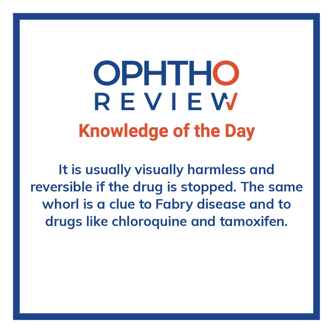 ophthoreview's tweet photo. Whorl-shaped deposits

#ophthoreview #ophthalmology #ophtho #ophthalmologyresidency #ophthalmologist #surgicaleducation #medicaleducation #meded #surgery #medicalstudent #medicine #medicalschool #resident #residency https://t.co/DZ9L23bprG