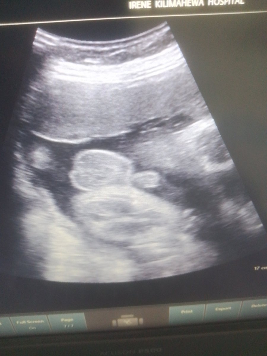 BasilG01's tweet photo. Role of Ultrasound in gender determination @ChroRadGirlie @BrunoNatuhwera https://t.co/7qFFLWfZ5M