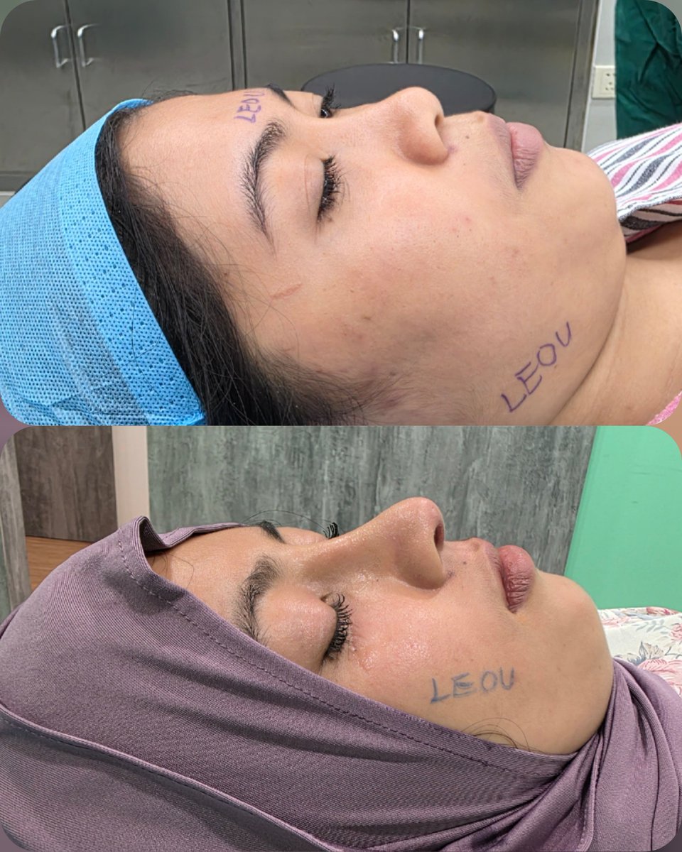 DrLeoSurgery's tweet photo. Recognition reflects professionalism. Responsibility defines the future.

At one of Asia’s most prestigious medical aesthetics award forums, Dr. Leo represented LEOU International Medical Group and shared our professional philosophy and international journey with industry leaders from Malaysia, Indonesia and across Asia.

From advanced eye and rhinoplasty procedures to breast surgery, post-pregnancy restoration, liposuction, BBL, facial rejuvenation and comprehensive anti-aging treatments, we believe that meaningful medical aesthetics goes far beyond changing appearance. It should help every patient rediscover confidence, youthfulness and a stronger sense of self through a safe, comfortable and professional medical experience.

Over the years, the LEOU International Medical Team has provided aesthetic, anti-aging and reconstructive services to more than 30,000 patients from over 100 countries and regions. Behind every transformation is a patient’s trust—and our continued commitment to medical ethics, surgical safety, refined aesthetics and responsible care.

Standing on this distinguished Asian medical aesthetics platform is not the destination; it represents an even greater responsibility. We will continue connecting outstanding global medical resources, advancing professional standards and demonstrating the strength of Chinese medical aesthetics to the world.

Our sincere appreciation goes to the organizers, our patients, partners and every member of the LEOU team. Together, we look forward to building a safer, more professional, transparent and internationally connected future for medical aesthetics.

#DrLeo #MedicalAestheticsLeader #GlobalPlasticSurgery #TrustedExpertise #LEOUInternational