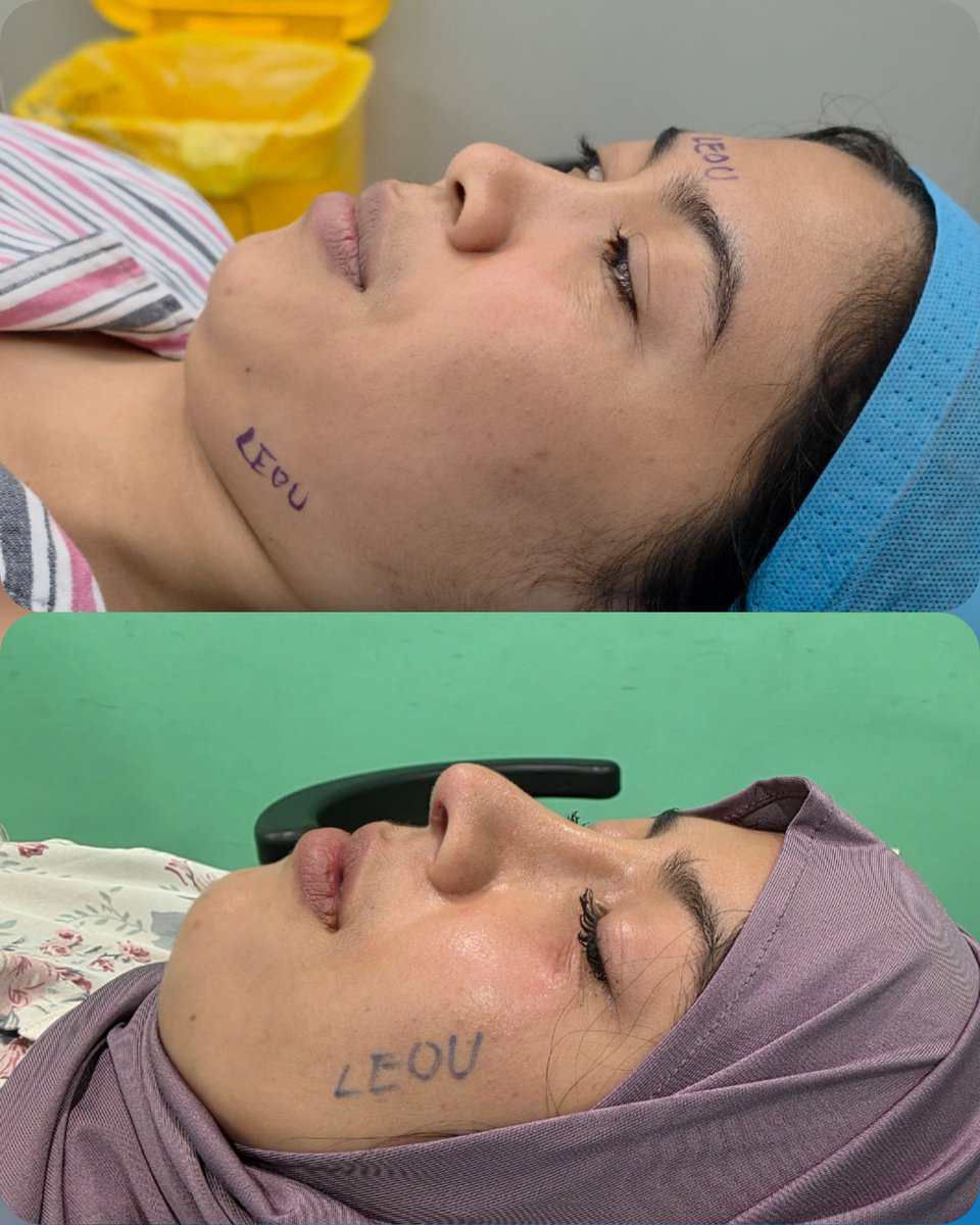 DrLeoSurgery's tweet photo. Recognition reflects professionalism. Responsibility defines the future.

At one of Asia’s most prestigious medical aesthetics award forums, Dr. Leo represented LEOU International Medical Group and shared our professional philosophy and international journey with industry leaders from Malaysia, Indonesia and across Asia.

From advanced eye and rhinoplasty procedures to breast surgery, post-pregnancy restoration, liposuction, BBL, facial rejuvenation and comprehensive anti-aging treatments, we believe that meaningful medical aesthetics goes far beyond changing appearance. It should help every patient rediscover confidence, youthfulness and a stronger sense of self through a safe, comfortable and professional medical experience.

Over the years, the LEOU International Medical Team has provided aesthetic, anti-aging and reconstructive services to more than 30,000 patients from over 100 countries and regions. Behind every transformation is a patient’s trust—and our continued commitment to medical ethics, surgical safety, refined aesthetics and responsible care.

Standing on this distinguished Asian medical aesthetics platform is not the destination; it represents an even greater responsibility. We will continue connecting outstanding global medical resources, advancing professional standards and demonstrating the strength of Chinese medical aesthetics to the world.

Our sincere appreciation goes to the organizers, our patients, partners and every member of the LEOU team. Together, we look forward to building a safer, more professional, transparent and internationally connected future for medical aesthetics.

#DrLeo #MedicalAestheticsLeader #GlobalPlasticSurgery #TrustedExpertise #LEOUInternational
