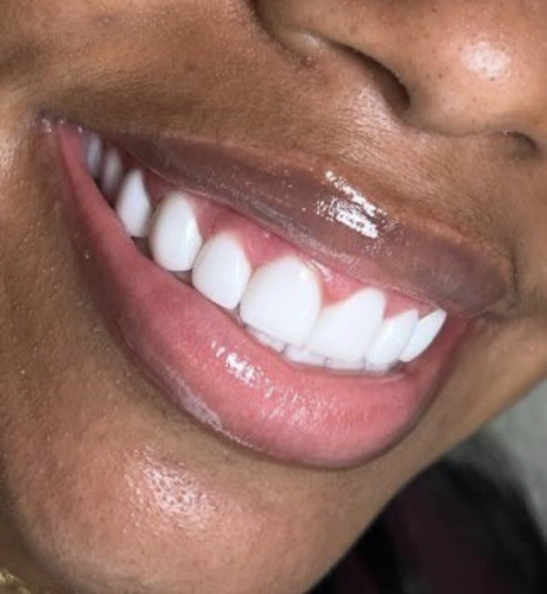 Dr_Pharouk's tweet photo. I don’t know who needs to hear this. Some dentists won’t tell you this, but I will for free. Never use these on your teeth if you don’t want dental issues.

People say they whiten teeth but won’t mention the damage.

Sandpaper, banana peels 🍌, lime 🍋‍🟩, hydrogen peroxide 🧬, acid water, baking soda 🥤, charcoal, salt.

What your teeth need most is daily flossing and brushing with fluoride toothpaste. If you need to whiten your teeth, see a dentist. 

Don’t say I didn’t tell you.