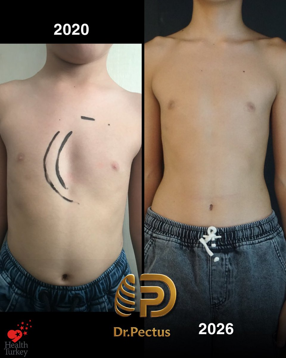 drpektus's tweet photo. 🩺🤍 Sometimes, the most successful treatment is the one that starts at the right time.

Our journey with this patient began in 2020, when he was only 7 years old.

#pectusexcavatum #vacuumbell #pectustreatment #chestwalldeformity #drpectus https://t.co/C2gc5HLJo6