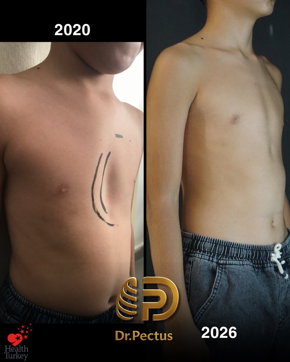 drpektus's tweet photo. 🩺🤍 Sometimes, the most successful treatment is the one that starts at the right time.

Our journey with this patient began in 2020, when he was only 7 years old.

#pectusexcavatum #vacuumbell #pectustreatment #chestwalldeformity #drpectus https://t.co/C2gc5HLJo6