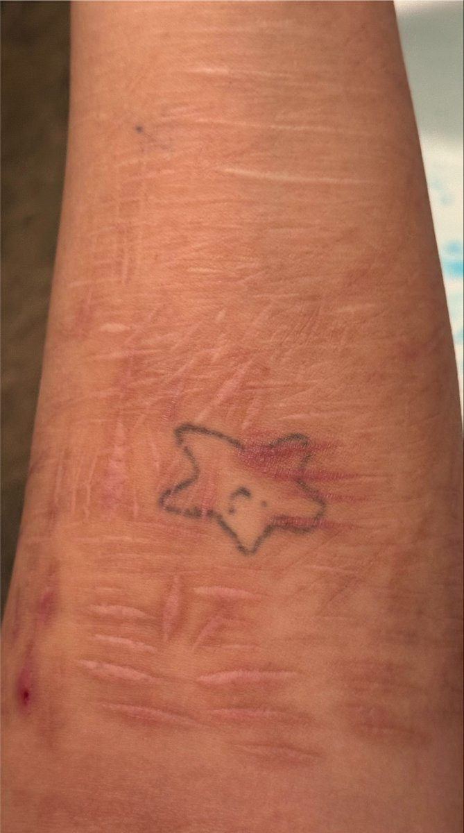 xana4200's tweet photo. I hateeee how my scars are in different directions 😖 https://t.co/qE0M68M8gW