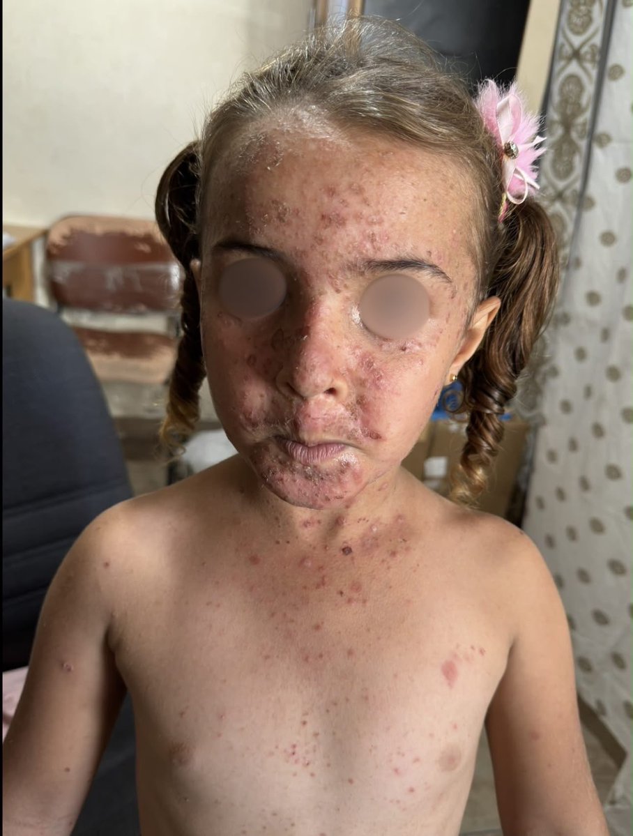 ezzingaza's tweet photo. No ten-year-old girl should be ashamed of her own face.

She lives with her parents in a tent, in a neighborhood where almost every home has been destroyed. The tent was supposed to be temporary, a shelter for a few weeks until they could return home.

Instead, it has been their home for more than two years.

Since the beginning of summer, the relentless heat, severe water shortages, poor sanitation, and harsh living conditions in the camp have taken a toll on her skin. Painful lesions began appearing across her face and body, gradually worsening and spreading.

When she came to our clinic, one of my colleagues examined her. Her parents had already done everything within their means to help her. They had managed to buy a single tube of the prescribed cream, but as her mother quietly explained:

“There wasn’t even enough to apply it twice.” The lesions continued to spread.

Then her mother lowered her voice and said something that revealed a different kind of suffering: “She doesn’t want to leave the tent anymore. She doesn’t want anyone to see her.”

At ten years old, she has begun hiding from her friends. She has learned to fear being seen.

To believe that isolation is easier than facing the eyes of other children.

What hurts her now is no longer only the physical pain of the lesions. It is the shame they have created around a face she should never have learned to hide.

Her mother summed up their reality in one heartbreaking sentence: “We can’t afford to buy her a tube of cream every day.”

This little girl did not choose any of this. She did not choose to spend her childhood in a tent. She did not choose to live through extreme heat without reliable access to clean water, adequate sanitation, or the basic conditions necessary to stay healthy. She did not choose to watch a treatable skin condition slowly take away her confidence and push her into isolation.

We were able to provide the medication she needs, and we will continue to monitor her condition and provide follow-up care. But every doctor working in Gaza is confronted with the same painful reality: medicine can treat the consequences, but it cannot remove the conditions that keep producing them.

No medication can compensate for years spent living in a tent. No clinic can prescribe adequate sanitation, safe housing, dignity, or the childhood these children have been denied. The real treatment she needs extends far beyond the walls of our clinic.

It is clean water instead of contaminated water. A safe home instead of a tent. Dignity instead of humiliation. A childhood instead of survival.

Until those things exist again, we will continue doing what we can: treating the infections, dressing the wounds, relieving the pain, and trying to protect what remains of our patients’ health and dignity.

But we must never allow ourselves to mistake treating the consequences for solving the cause.

And perhaps the greater failure belongs to a world that has watched children live without the most basic conditions of human dignity for so long that their suffering risks becoming ordinary.

#SurvivalTestimony