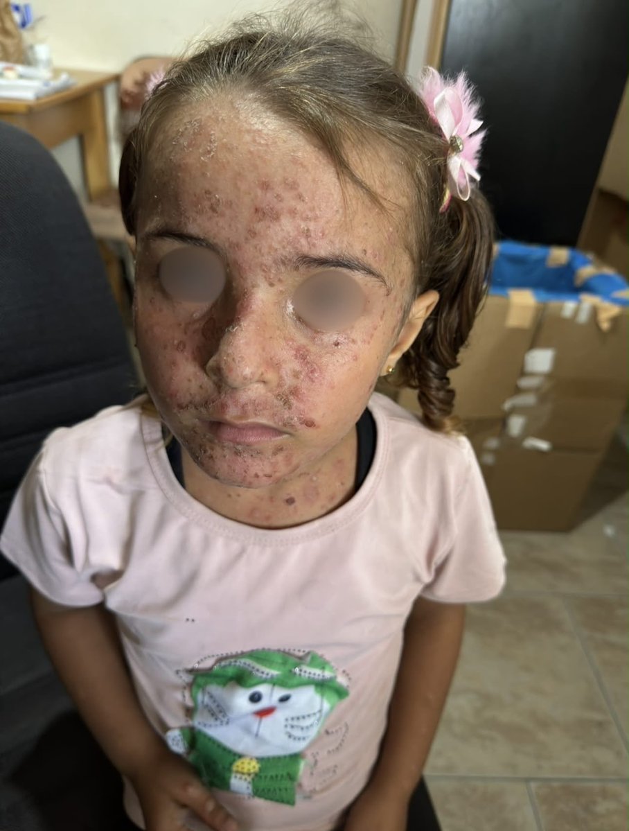 ezzingaza's tweet photo. No ten-year-old girl should be ashamed of her own face.

She lives with her parents in a tent, in a neighborhood where almost every home has been destroyed. The tent was supposed to be temporary, a shelter for a few weeks until they could return home.

Instead, it has been their home for more than two years.

Since the beginning of summer, the relentless heat, severe water shortages, poor sanitation, and harsh living conditions in the camp have taken a toll on her skin. Painful lesions began appearing across her face and body, gradually worsening and spreading.

When she came to our clinic, one of my colleagues examined her. Her parents had already done everything within their means to help her. They had managed to buy a single tube of the prescribed cream, but as her mother quietly explained:

“There wasn’t even enough to apply it twice.” The lesions continued to spread.

Then her mother lowered her voice and said something that revealed a different kind of suffering: “She doesn’t want to leave the tent anymore. She doesn’t want anyone to see her.”

At ten years old, she has begun hiding from her friends. She has learned to fear being seen.

To believe that isolation is easier than facing the eyes of other children.

What hurts her now is no longer only the physical pain of the lesions. It is the shame they have created around a face she should never have learned to hide.

Her mother summed up their reality in one heartbreaking sentence: “We can’t afford to buy her a tube of cream every day.”

This little girl did not choose any of this. She did not choose to spend her childhood in a tent. She did not choose to live through extreme heat without reliable access to clean water, adequate sanitation, or the basic conditions necessary to stay healthy. She did not choose to watch a treatable skin condition slowly take away her confidence and push her into isolation.

We were able to provide the medication she needs, and we will continue to monitor her condition and provide follow-up care. But every doctor working in Gaza is confronted with the same painful reality: medicine can treat the consequences, but it cannot remove the conditions that keep producing them.

No medication can compensate for years spent living in a tent. No clinic can prescribe adequate sanitation, safe housing, dignity, or the childhood these children have been denied. The real treatment she needs extends far beyond the walls of our clinic.

It is clean water instead of contaminated water. A safe home instead of a tent. Dignity instead of humiliation. A childhood instead of survival.

Until those things exist again, we will continue doing what we can: treating the infections, dressing the wounds, relieving the pain, and trying to protect what remains of our patients’ health and dignity.

But we must never allow ourselves to mistake treating the consequences for solving the cause.

And perhaps the greater failure belongs to a world that has watched children live without the most basic conditions of human dignity for so long that their suffering risks becoming ordinary.

#SurvivalTestimony