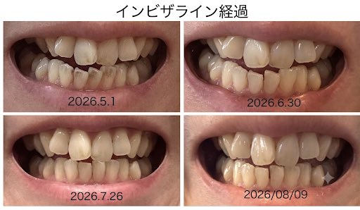 ojine_inv's tweet photo. インビザライン経過 https://t.co/Jj0BaD5Dk7