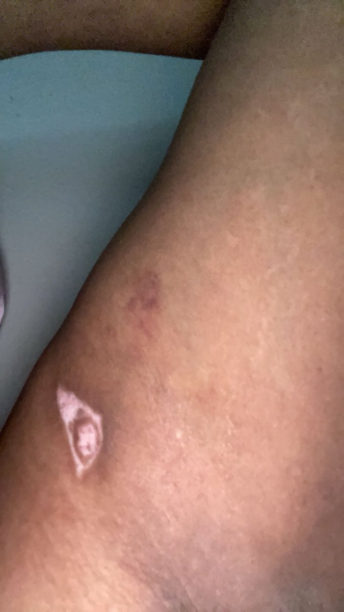StacyIsTired's tweet photo. TW: Physical abuse/Mutual Aid

Being disabled kept me in relationship I didn’t deserve yet didn’t know how to leave for years. I depended on this person and they used that against me. Today I’m DONE. Please if you can find it in your hearts to help me with booking hotel/food: PT1 https://t.co/kSfGINkC0j