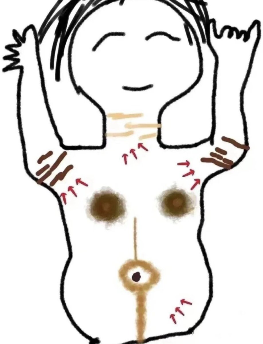 Awawayc6o's tweet photo. こういう全身の黒ずみには、
  
①グルタチオン
②ハイドロキノン

の組み合わせで綺麗に消えるよ 
ボディスクラブで色素沈着ケア→強力美白成分ハイドロキノンクリームでまっくろの脇治る。 https://t.co/m7bh9rx4xP