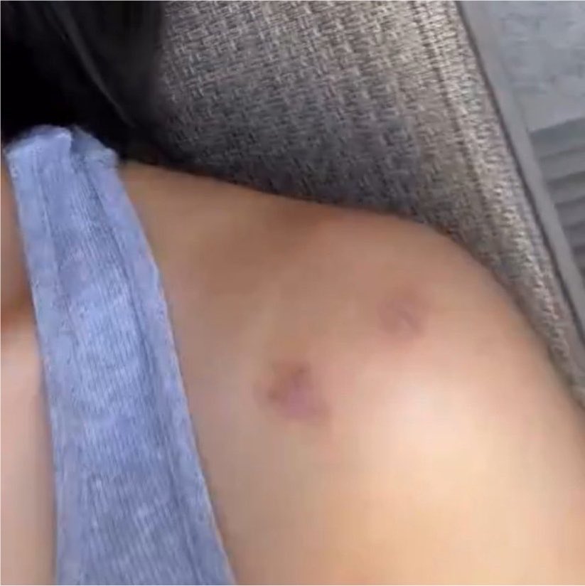 wooj4sho's tweet photo. woojin giving a cute nickname “coconut scar” to his surgery scars.. he is so witty about it… so cutee🥺❤️‍🩹

#WOOJIN #우진 https://t.co/VFFryLTwwz