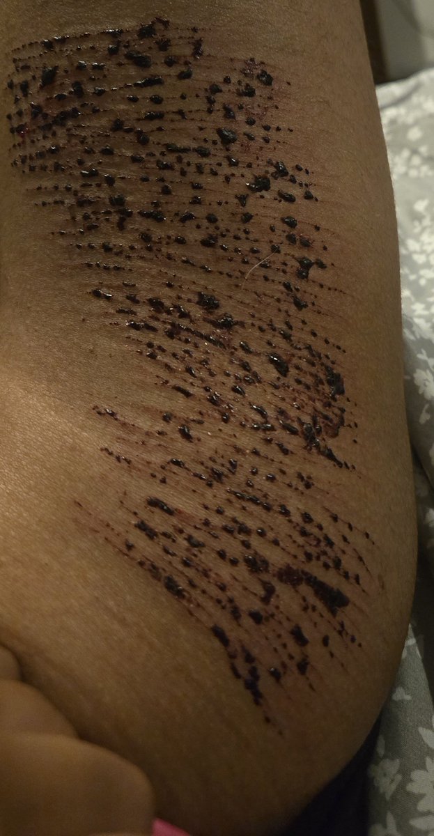_Gho5tly_'s tweet photo. #shtwt #slittwt #sh #selfharm #cutting #shedtwt #slashflash
ALL SFX MAKEUP NOT REAL AI GENERATED HALLOW MAKEUP
Never used this much fake blood and the scabs are so interesting to me idk why I'll probably take a shower and do more but Idk yet https://t.co/7F886v4Sti