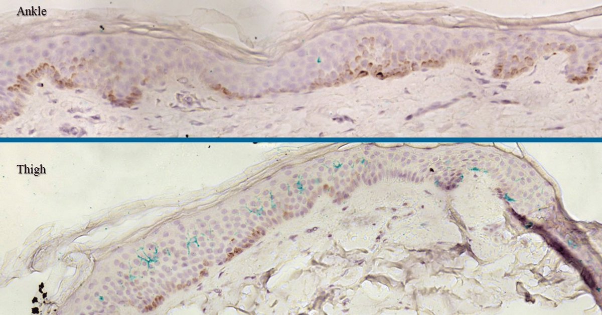 vipintukur's tweet photo. Can damaged small nerve fibres actually regenerate in post-Covid 19 vaccination syndrome?

➡️ A striking case report describes a woman with small-fibre neuropathy (SFN) following #BNT162b2 vaccination whose symptoms improved after 8 cycles of #IVIG, accompanied by a remarkable rise in intraepidermal nerve fibre density (IENFD)—from 6→9 fibres/mm at the ankle and 6→8 at the thigh.  1/