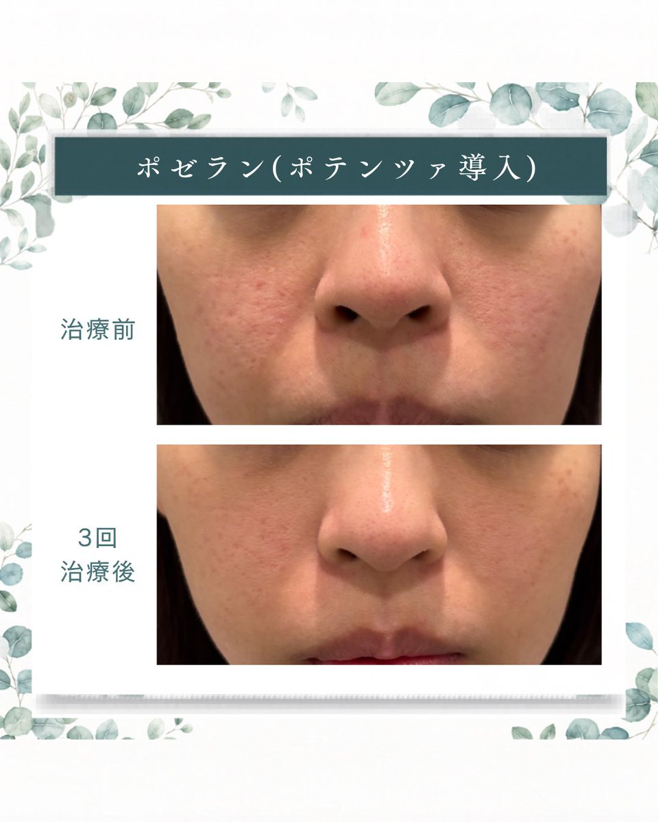 oracleclinic's tweet photo. 【毛穴・肝斑・赤み改善】
ポゼラン症例ご紹介📸

毛穴と色ムラが改善しました👏
現在ポテンツァとシルファームXの
30%OFFモニター募集中📣

お問い合わせはLINEへ📲
https://t.co/zvaxkQQFh8 https://t.co/v0NhPr3FUV