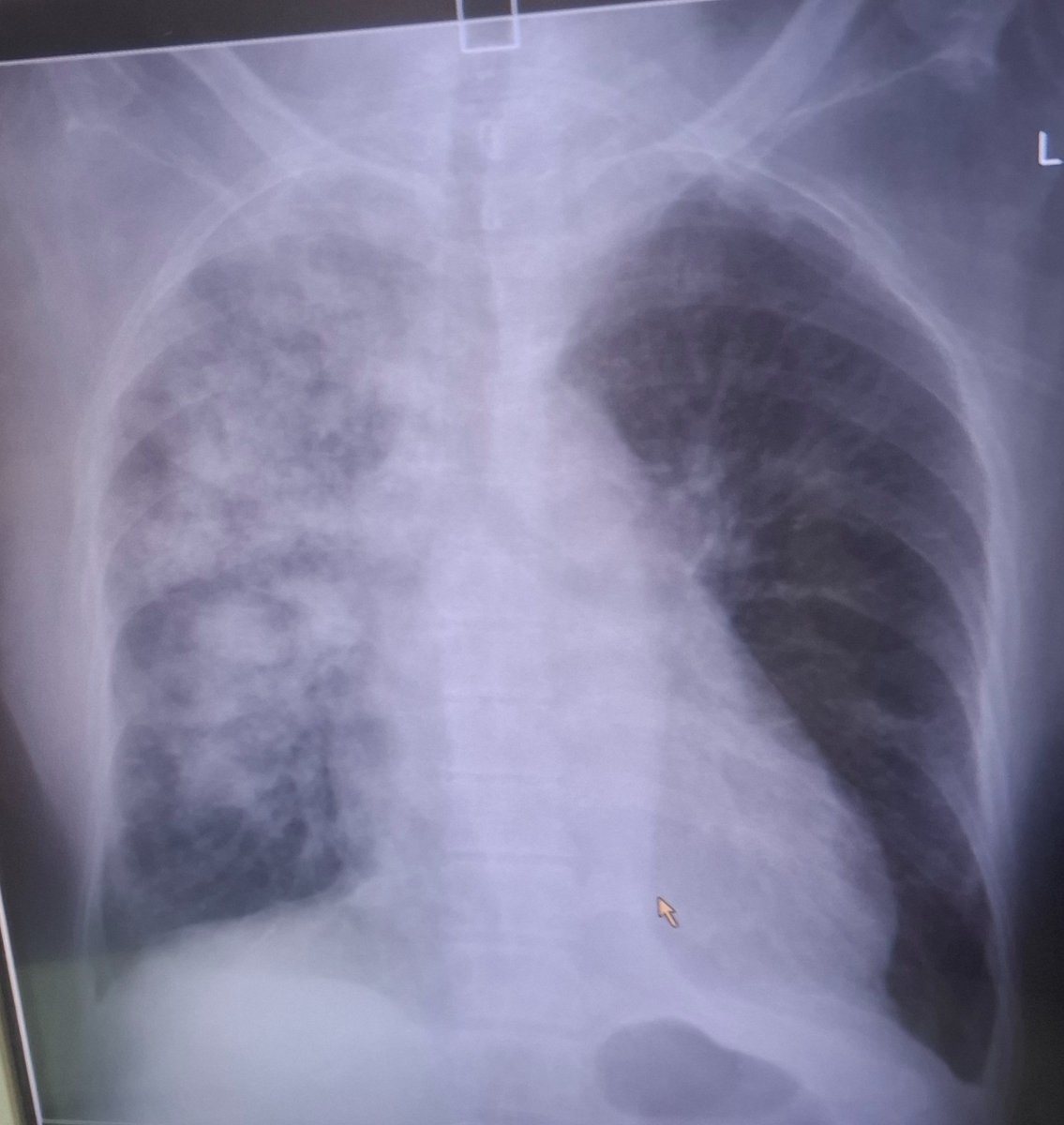pahadi__doc's tweet photo. 60 year old female with complaints of hemoptysis &amp; shortness of breath. 

#MedX https://t.co/Ul1aS3k4cT