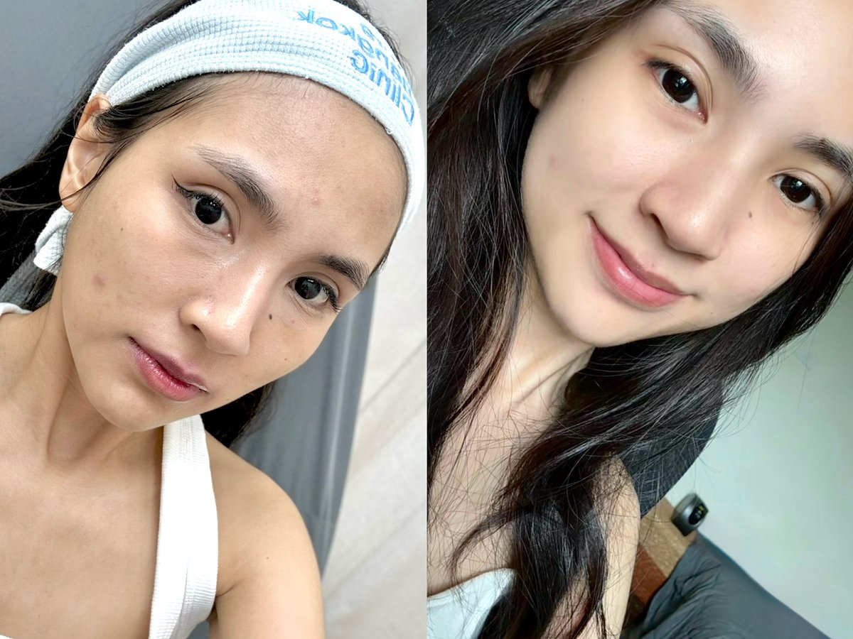 barbie_poko's tweet photo. ขอพื้นที่อวยยศหัตถการแรกในชีวิตที่ไปทำหน่อย ปกติเป็นคนกลัวเข็มมากกก แล้วก็ไม่เคยทำหัตถการเลย😂 ที่ผ่านมาก็ใช้สกินแคร์ลดสิวลดรอยมาตลอด แต่ต้องใช้เวลา บวกกับช่วงนี้แทบไม่มีเวลาดูแลตัวเอง เลยตัดสินใจลองทำ Acne Solution + Aura Bright ที่ Aura Bangkok Clinic

แล้วทุกคนดูนี่  เทียบ Before-After ให้ดูชัดเลยๆ ผิวคือดูไบรท์ขึ้น รอยสิวก็ดูจางลง หน้าโดยรวมดูสดใสขึ้น แต่งหน้าติดผิวขึ้นกว่าเดิม อันนี้แค่ทำครั้งแรกเองนะ ถ้าดูแลต่อเนื่องจะเห็นผลชัดขึ้นอีก

และที่สำคัญช่วงนี้ Aura Bangkok Clinic จัดโปร 8.8 ฉลองครบรอบ 10 ปี อยู่นะ 🥹 โปรที่ 2 แค่ 8 บาท คือคุ้มมากกก แถมเป็นโปรพิเศษช่วง 1–31 ส.ค. 69 เท่านั้น ใครกำลังเล็งไว้ เราว่าเป็นช่วงที่น่าเข้าไปลองเลย🩵

#AuraBangkokClinic