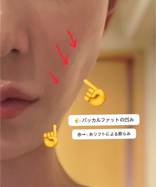 mukundetaihen's tweet photo. 7〜8年前に取ったバッカルファット
しっかりと凹んでしまい色んな
クリニックにカウンセリングへ

👨🏻‍⚕️ 「 糸リフトで上げたら凹みも
         気にならなくなりますよ！」

その言葉を信じて糸リフトしました。

糸リフトは昔した事あるけど必要以上に
今回引き上げられてる気がすると思い
先生に伝えた。そして凹んだ箇所が
上に上がっただけ...も伝えると...

👨🏻‍⚕️ 「 日にち経てば馴染みます！ 」

2年後の今..糸リフトの箇所は拘縮し
いまだにひきつれを起こしてる😢

謎にコラーゲン生成されているのか
表面の凹凸が出来上がってしまった。