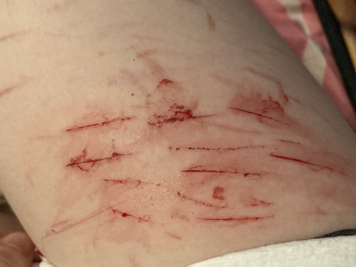 mikantsumkiirl's tweet photo. bruh what happened i used to be able to go deep #slittwt #988twt #cutspo #shedtwt #shtwt #selfharm https://t.co/4eqdIsR2IJ