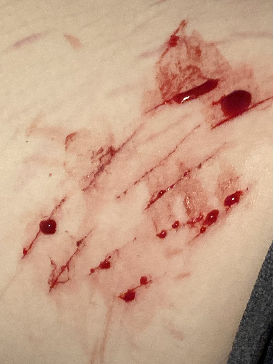 mikantsumkiirl's tweet photo. bruh what happened i used to be able to go deep #slittwt #988twt #cutspo #shedtwt #shtwt #selfharm https://t.co/4eqdIsR2IJ