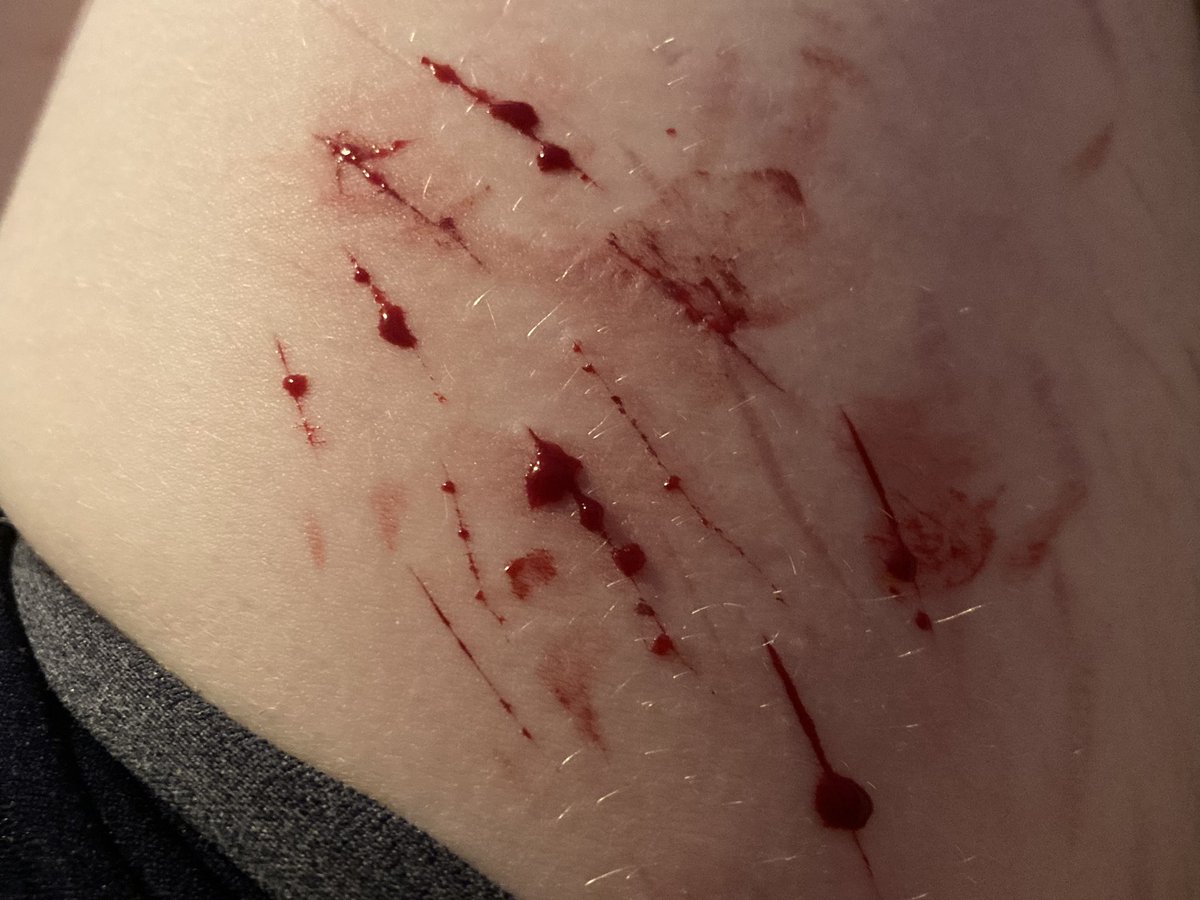 mikantsumkiirl's tweet photo. bruh what happened i used to be able to go deep #slittwt #988twt #cutspo #shedtwt #shtwt #selfharm https://t.co/4eqdIsR2IJ
