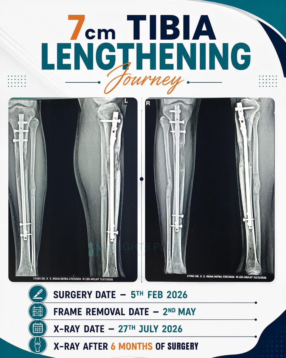 HeightsPlus's tweet photo. 7 CM Tibia Lengthening Journey 🦴📈

A closer look at the X-ray progression of a patient who achieved 7 CM of tibia lengthening following limb lengthening surgery.

#TibiaLengthening #LimbLengthening #TibiaLengtheningJourney #7cmHeightGain #LimbLengtheningSurgery #HeightIncrease https://t.co/9zHjOhesaZ