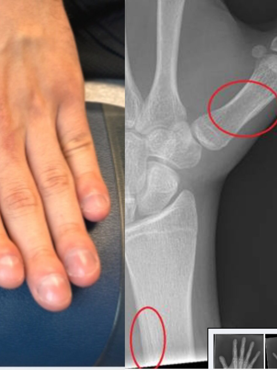 reinmd77's tweet photo. 16yo♂️1yr📈“swellg”nails
➡️Pic
ROS✔️
⚗️✔️
CXR✔️
🎞️!
◾incomplete pachydermoperiostosis (primary hypertrophic osteoarthropathy)

https://t.co/MgeggCohMK https://t.co/a4YYgzzX2a
