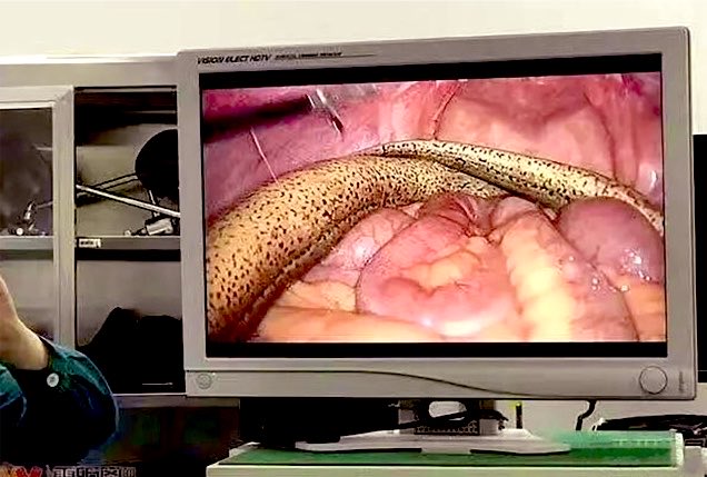 drkeithsiau's tweet photo. An unusual view seen during laparoscopic abdominal surgery. What is the likely explanation here? https://t.co/rbajTiTuVN
