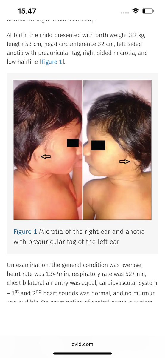 worksakun's tweet photo. HINDARI RETINOL DALAM BENTUK APAPUN (RETINAL, TRETINOIN, ISO TRETINOIN) KALAU KAMU SEDANG HAMIL ATAU MAU HAMIL. 

Kenapa retinoid dilarang saat hamil? Bentuk aktif dari retinol acid berfungsi mengatur ekspresi gen selama embrio berkembang. Masalahnya, kalau sinyal retinoic acid berlebihan, ia bisa mengaktifkan reseptor RAR/RXR secara tidak tepat dan mengacaukan gen perkembangan seperti HOX yang menentukan pola pembentukan tubuh. Akibatnya, proses pembentukan otak, wajah, jantung, telinga, dan organ lainnya bisa terganggu dan menyebabkan cacat bawaan.