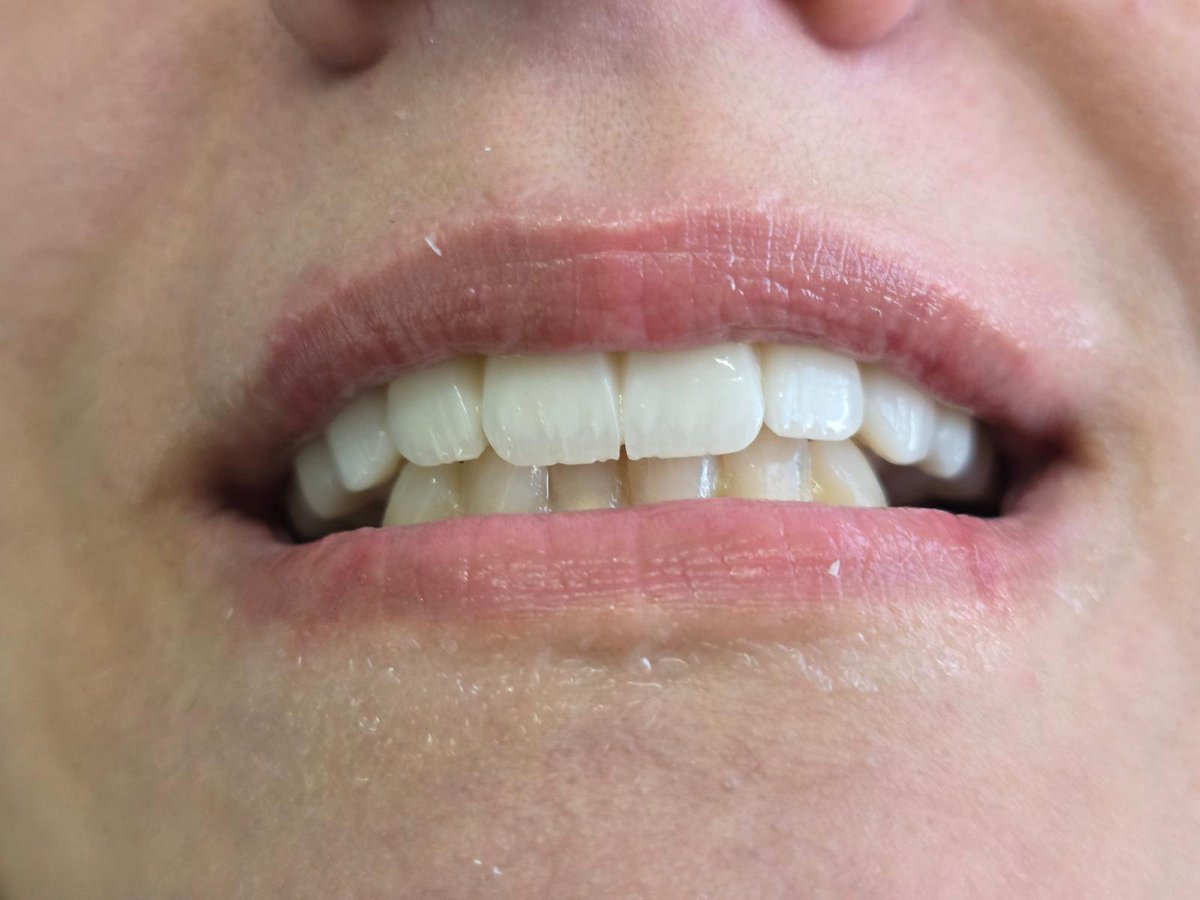 em_kaream's tweet photo. Thank God, this is the final picture of my teeth. Thanks to you, I got the most beautiful, perfect smile. I need to pay the remaining dental bills to cover the rest.I need to repay $1,929. We only paid the doctor $500. Please don't leave me. ♥️🙏 https://t.co/k5Ru5tabol