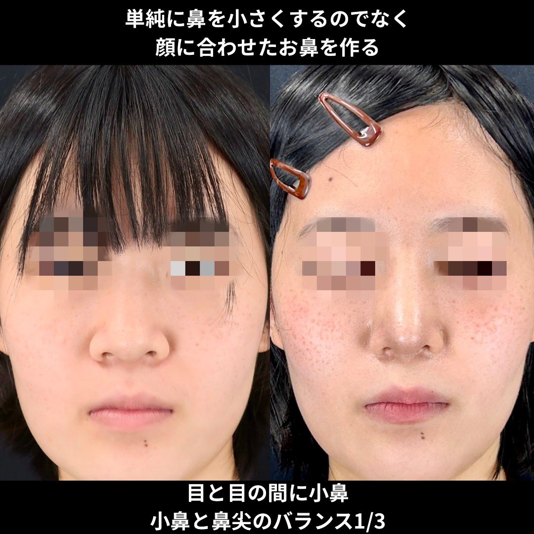 Biyou_no_DR's tweet photo. 鼻を小さくするのではなく表情に合わせた鼻を作る

大きい鼻のお悩みには鼻を小さくする手術は鼻尖形成や小鼻縮小などありますが、本質的には鼻を小さくすると言うよりも、顔全体の大きさに対して鼻の比重を下げる事で、目立たない鼻を作ると言うことだと思います。
こちらの症例では鼻先の手術と小鼻縮小を行うことによって、鼻先を鼻全体の3分の1に、小鼻は目頭間の距離より中に収めると言うところを基準に手術をしています。
そうする事で、顔に自然と馴染んだ鼻の存在感になるので極端に大きな印象や浮いた鼻を改善するのに非常に効果的です。

#鼻尖形成
#小鼻縮小
#鼻フル