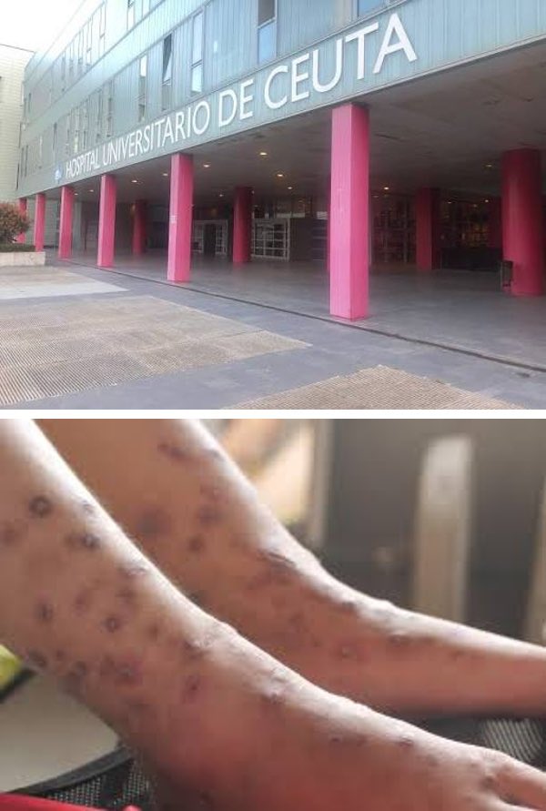 AltRightEspan's tweet photo. 🇪🇸🇲🇦 Alerta en Ceuta por un brote de Sarna con muchos contagiados. 

Fuentes sanitarias alertan también de un varón con un caso de tuberculosis grave diagnosticado en Marruecos y que entró en el asalto a Ceuta y ha estado paseando durante días antes de dirigirse al hospital. https://t.co/dSVNyCsFIP