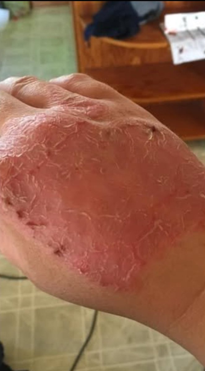 JoeTippensl's tweet photo. Okay, I'm going to share something real.
Psoriasis is a bitch. I've had it for 20 years.

20 years of itching. 20 years of hiding. 20 years of feeling like my skin wasn't mine.

I couldn't take it anymore.
I was covered completely in 2024. Head to toe. It was depressing. The kind of depressing that makes you not want to leave the house.

I tried everything. Creams. Shots. Prescriptions. Nothing worked. Not really.

Then I found a page about Ivermectin and cancer.
And I read something that stopped me: Psoriasis might be caused by parasites.

I thought, "What the hell – I deworm my animals. Why not myself?"

So I did it.

3 rounds of Ivermectin

3 rounds of Safeguard (Fenbendazole)

Total 6 weeks

1 week rest after each round

And my friends… it freaking worked.
I'm not crawling under my skin anymore.

I sleep better.

That time of the month? Barely makes me sick now.

I go number 2 every dang day – which I never did before.

My skin is healed.
I can't believe I'm saying that.

After 20 years of suffering.

I trust my gut.
And I'm glad I did.

Call me crazy. I don't care. Because I'm not crazy.

I'm just someone who tried something different and got her life back.