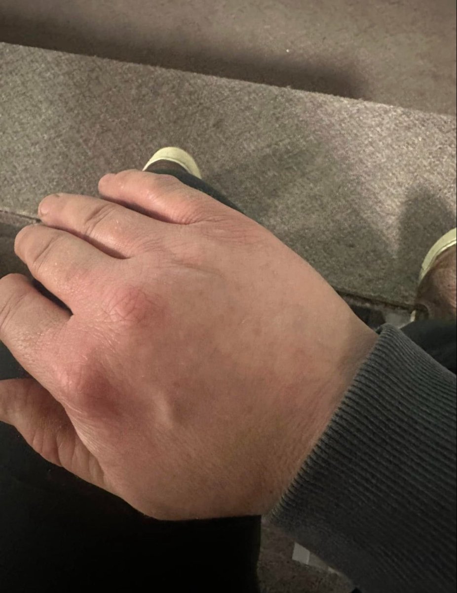 JoeTippensl's tweet photo. Okay, I'm going to share something real.
Psoriasis is a bitch. I've had it for 20 years.

20 years of itching. 20 years of hiding. 20 years of feeling like my skin wasn't mine.

I couldn't take it anymore.
I was covered completely in 2024. Head to toe. It was depressing. The kind of depressing that makes you not want to leave the house.

I tried everything. Creams. Shots. Prescriptions. Nothing worked. Not really.

Then I found a page about Ivermectin and cancer.
And I read something that stopped me: Psoriasis might be caused by parasites.

I thought, "What the hell – I deworm my animals. Why not myself?"

So I did it.

3 rounds of Ivermectin

3 rounds of Safeguard (Fenbendazole)

Total 6 weeks

1 week rest after each round

And my friends… it freaking worked.
I'm not crawling under my skin anymore.

I sleep better.

That time of the month? Barely makes me sick now.

I go number 2 every dang day – which I never did before.

My skin is healed.
I can't believe I'm saying that.

After 20 years of suffering.

I trust my gut.
And I'm glad I did.

Call me crazy. I don't care. Because I'm not crazy.

I'm just someone who tried something different and got her life back.