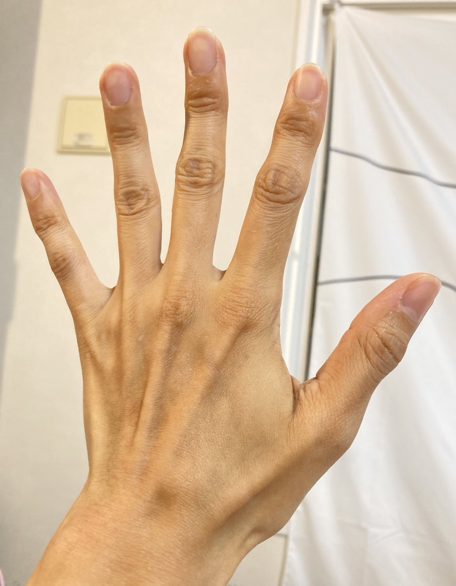 Nanocon4's tweet photo. ←ビフォア　DT3→
胸と同じくゲソきった手にも脂肪を入れてみた

冷え性の人は交感神経優位で体幹の熱を優先して守るため下半身が太りやすいそう

なぜか上半身はゲッソリ https://t.co/Q6DbmUZDhX