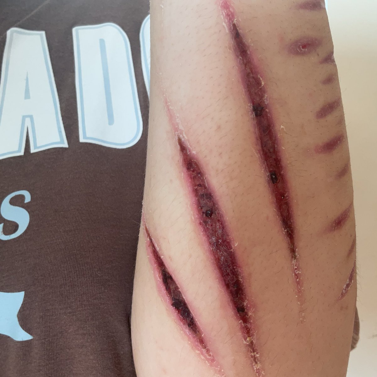 literalyamyrose's tweet photo. healing progress on my recent fake sfx makeup wounds yay
the shrinkage is insane but they are healing quickly which i’m happy about 🥹🥹 FAKE SFX MAKEUP THIS IS NOT REAL ALL FAKE
#shedrtwt #ouchietwt #988twt https://t.co/skOKfrUeD4